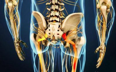 Sciatica: perché non è sinonimo di ernia del disco.